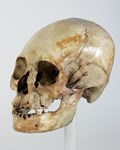 Artificial Cranial Deformation